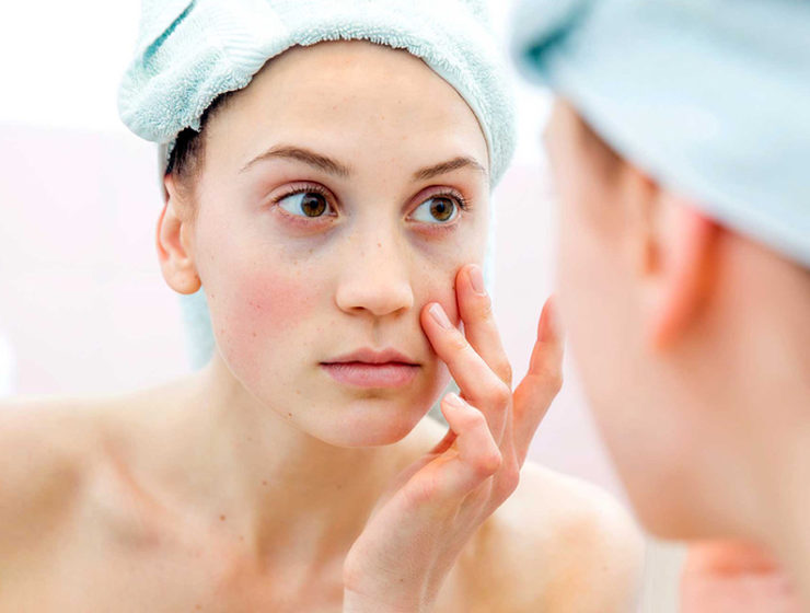 Rid of Dark Circles