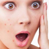 Reasons That Cause Pimples - The Health Blog - Fidoc